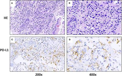 Case Report: Severe Immune-Related Cholestatic Hepatitis and Subsequent Pneumonia After Pembrolizumab Therapy in a Geriatic Patient With Metastic Gastric Cancer